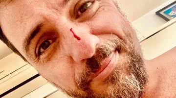 Rodrigo Lombardi surge com rosto e peitoral machucados e assusta fãs - Foto: Reprodução/Instagram